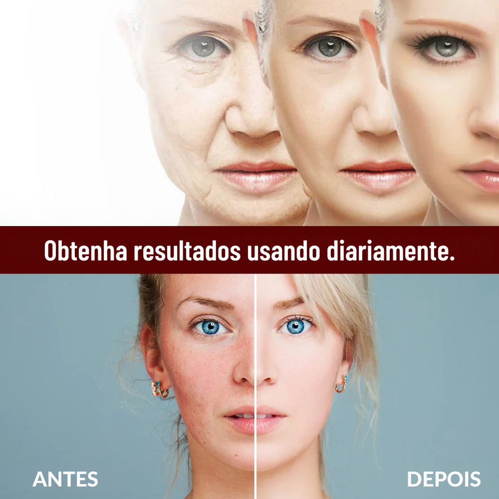 Creme Facial Antirrugas de Arroz – Tratamento para Acne, Melasma e Clareamento - Compre 1 e Leve 3