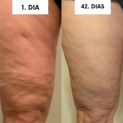 SheVitality™ Tratamento Profissional anticelulite