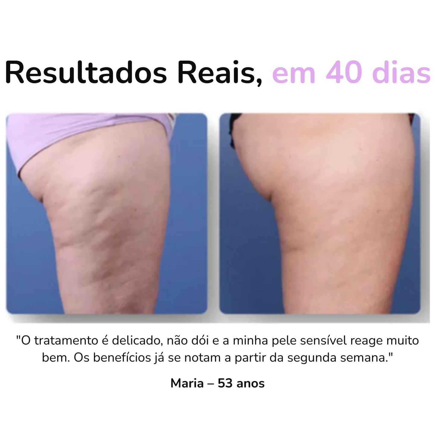SheVitality™ Tratamento Profissional anticelulite