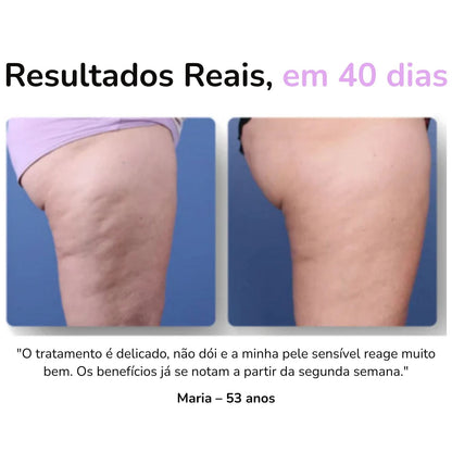 SheVitality™ Tratamento Profissional anticelulite